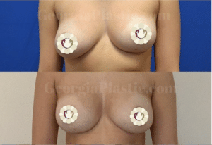 Scarless Breast Lift